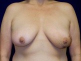 Breast Reconstruction before and after - before