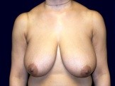 Breast Reduction before and after - before