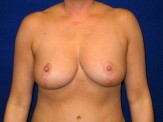 Breast Reduction before and after - after