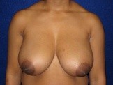 Breast Reduction before and after - before