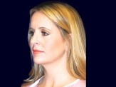 Chin Liposuction before and after - after