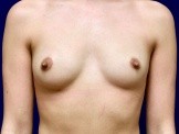 Breast Augmentation before and after - before