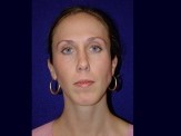 Chin Implant before and after - after