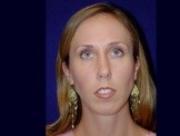Chin Implant before and after - before