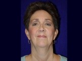 Facelift & Chin Implant before and after - before