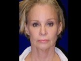 Facelift with Browlift & Chin Implant before and after - after