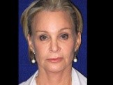 Facelift with Browlift & Chin Implant before and after - before