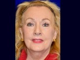Facelift & Browlift before and after - after