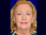 Facelift & Browlift before and after - before