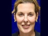 Lower Facelift & Upper Eyelid Surgery before and after - after