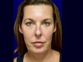 Lower Facelift & Upper Eyelid Surgery before and after - before