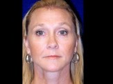 Facelift with Browlift & Upper Eyelid Surgery before and after - after