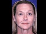 Facelift with Browlift & Upper Eyelid Surgery before and after - before