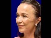 Lower Facelift before and after - after