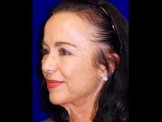 Lower Facelift before and after - before