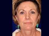 Lower Facelift & Upper Eyelid Surgery before and after - after