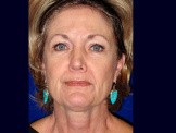 Lower Facelift & Upper Eyelid Surgery before and after - before
