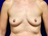 Breast Augmentation Using Galaflex Scaffold before and after - before