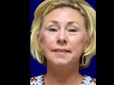 Facelift with Browlift and Eyelid Surgery before and after - after