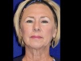 Facelift with Browlift and Eyelid Surgery before and after - before
