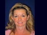 Facelift with Upper & Lower Eyelid Surgery & Browlift before and after - after