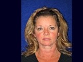 Facelift with Upper & Lower Eyelid Surgery & Browlift before and after - before