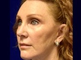 Facelift Revision & Browlift before and after - after
