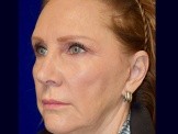 Facelift Revision & Browlift before and after - before