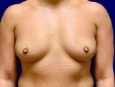 Breast Augmentation before and after - before