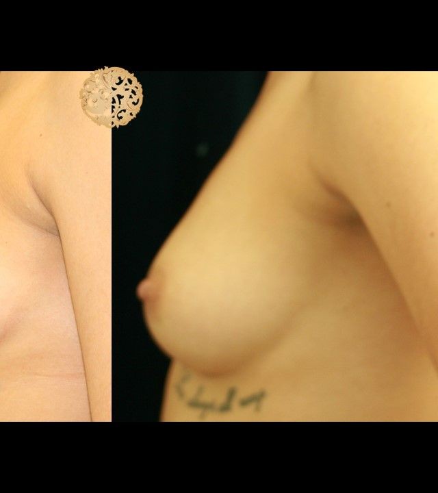 PRP Breast Booster before and after - after