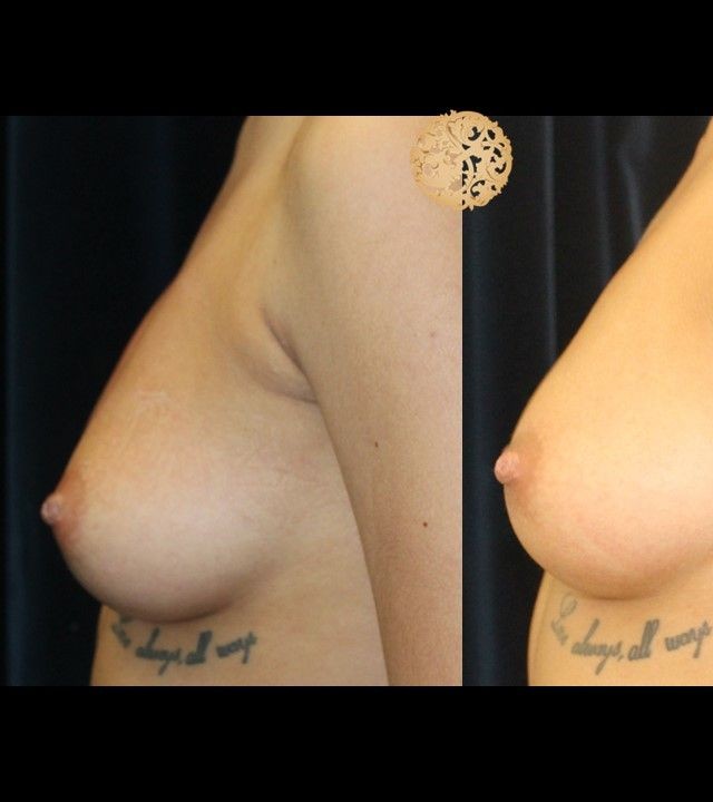 PRP Breast Booster before and after - before