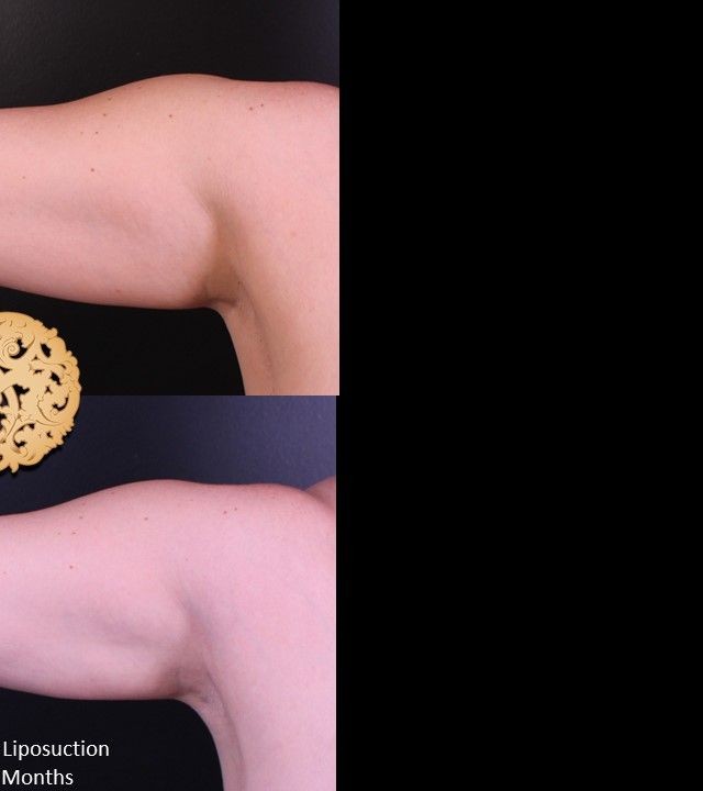 Liposuction before and after - after