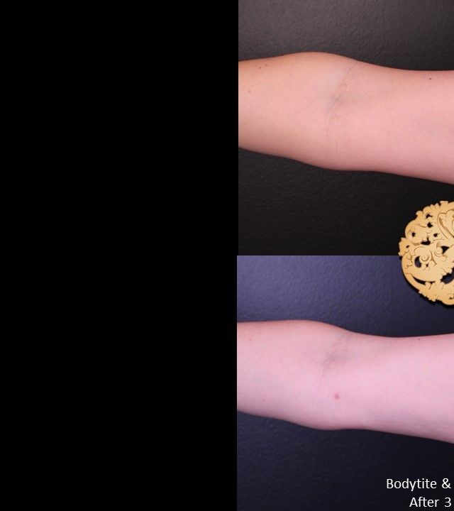 Liposuction before and after - before