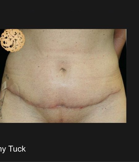 Mini Tummy Tuck before and after - after