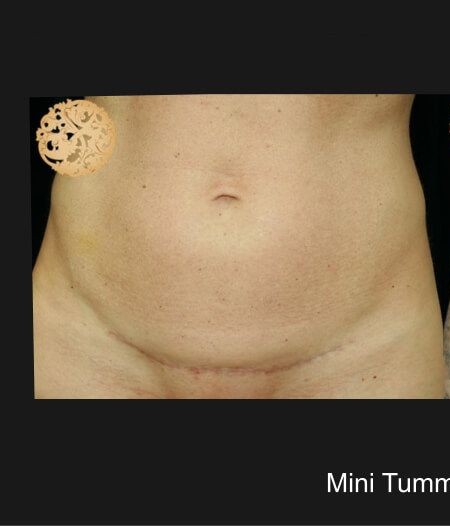 Mini Tummy Tuck before and after - before