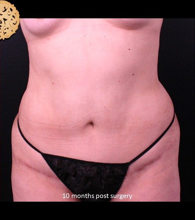 Mini Tummy Tuck before and after - after