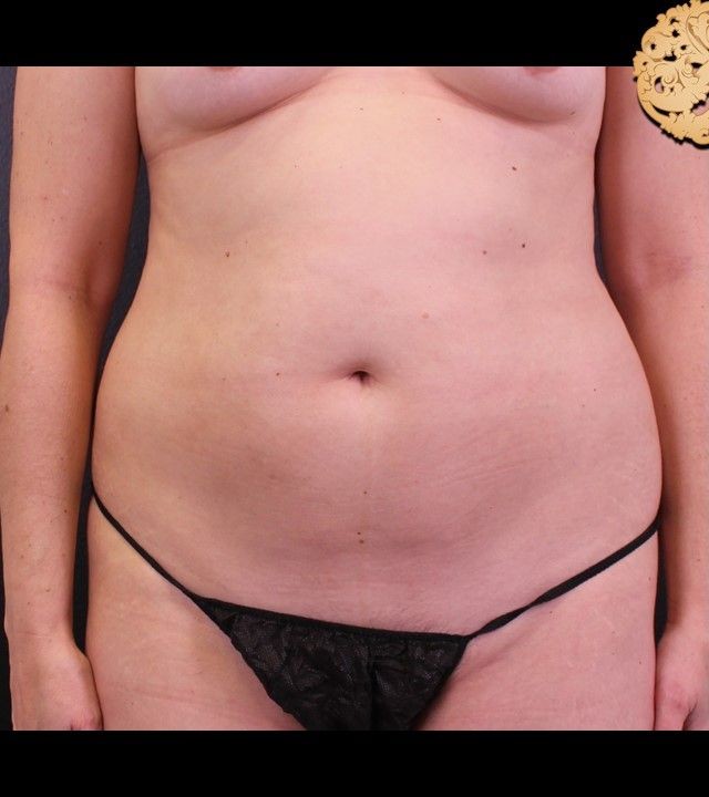 Mini Tummy Tuck before and after - before