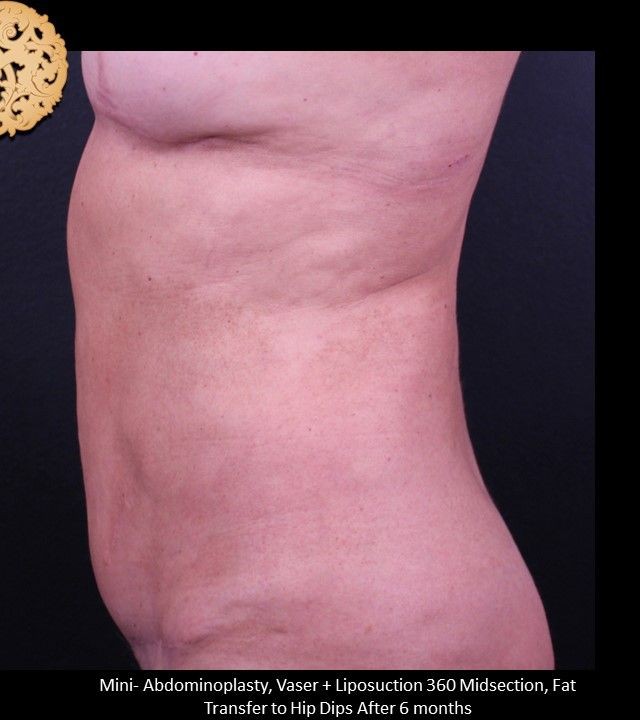Mini Tummy Tuck before and after - after