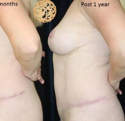 Mommy Makeover before and after - after