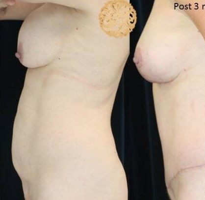 Mommy Makeover before and after - before