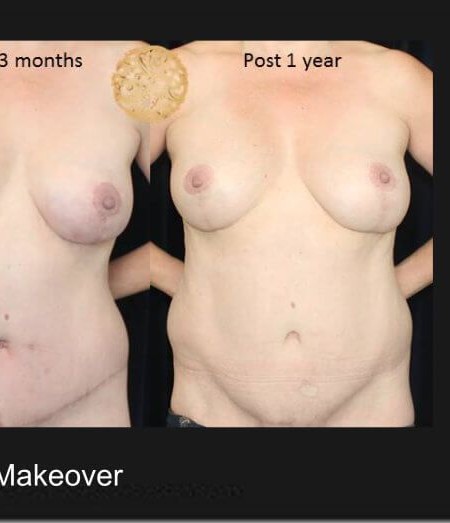 Mommy Makeover before and after - after