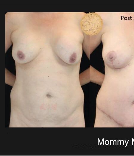 Mommy Makeover before and after - before