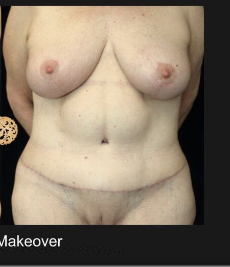 Mommy Makeover before and after - after