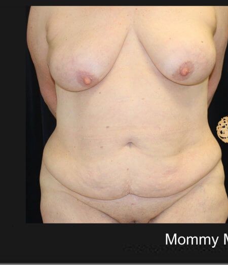 Mommy Makeover before and after - before