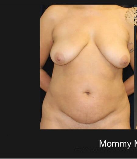 Mommy Makeover before and after - before