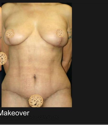 Mommy Makeover before and after - after