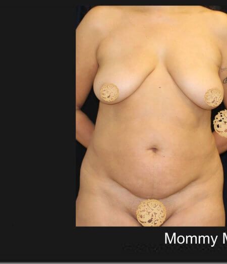 Mommy Makeover before and after - before