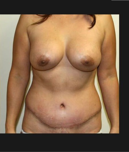 Mommy Makeover before and after - after