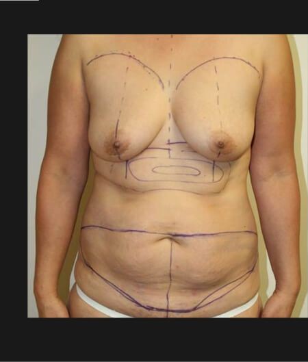 Mommy Makeover before and after - before