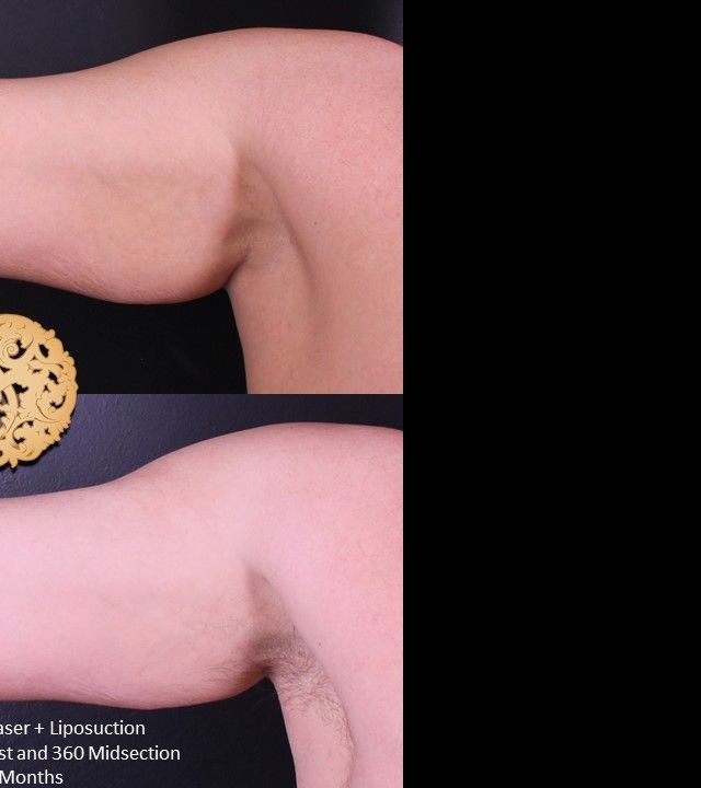 Liposuction before and after - after